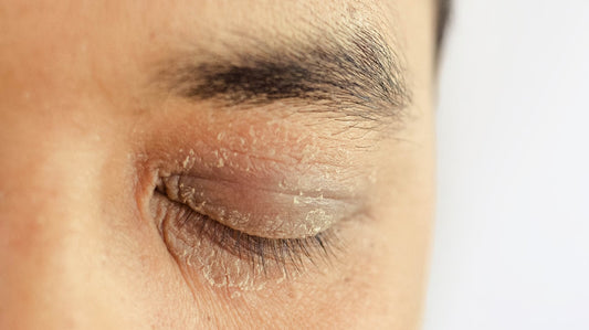 how to treat dry skin around eyes