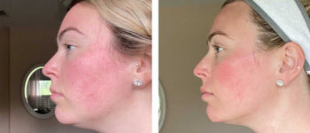 Before After Skin