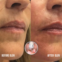 4 Glov Micro Infusion System + 12 Serums + 8 Needles