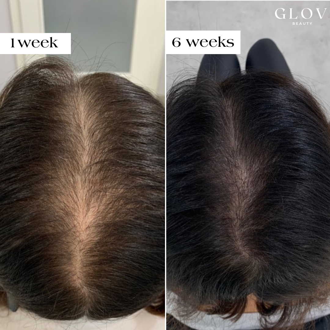 Glov Beauty Hair Regrowth System - Combat Hair Loss & Stimulate Growth ...