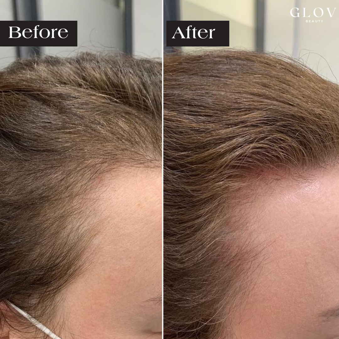 Glov Hair Regrowth System